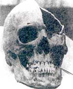 Череп Бормана, обнаруженный в Берлине в декабре 1971 года